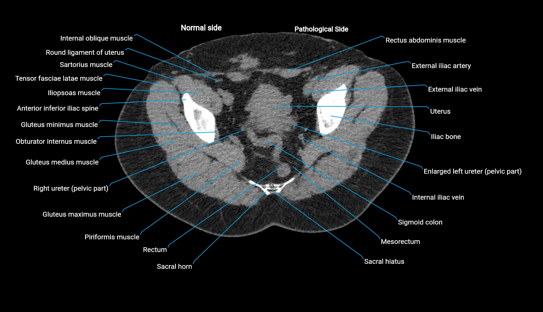 CT KUB axial cross sectional anatomy  radiology image -img-00201-00145.webp